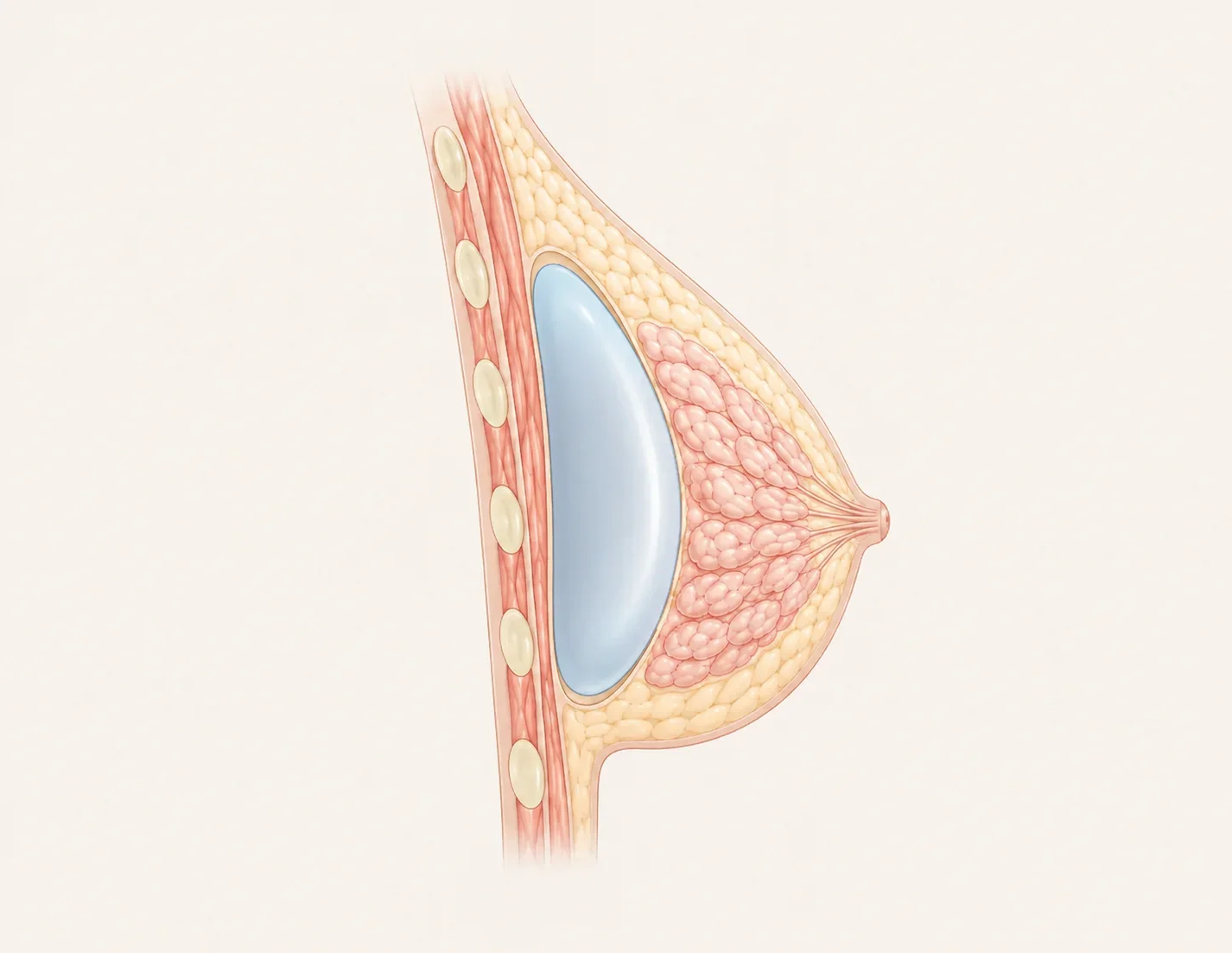 Subfascial/Subglandular (Bawah Fasia/Bawah Kelenjar)
