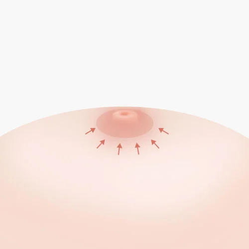 Reduksi Areola
