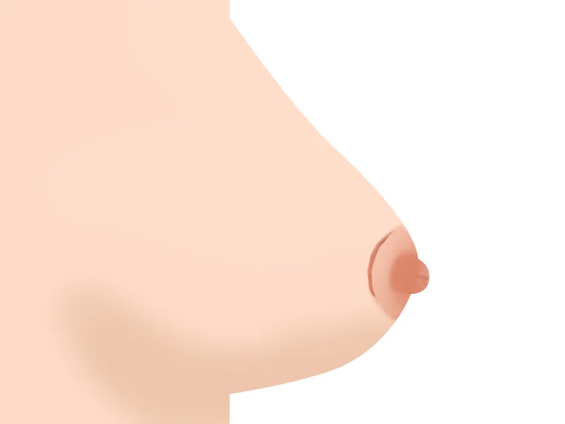 Bekas Luka di Sekitar Areola Pascaoperasi