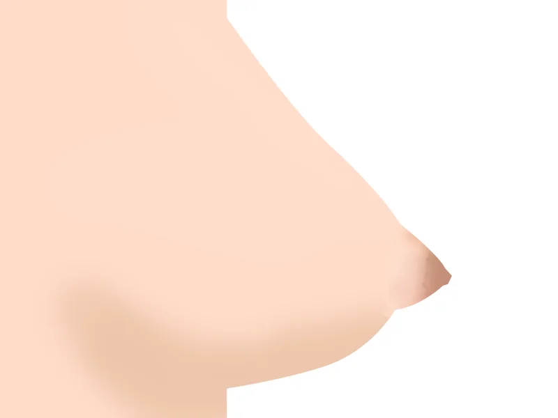 Hernia Areola